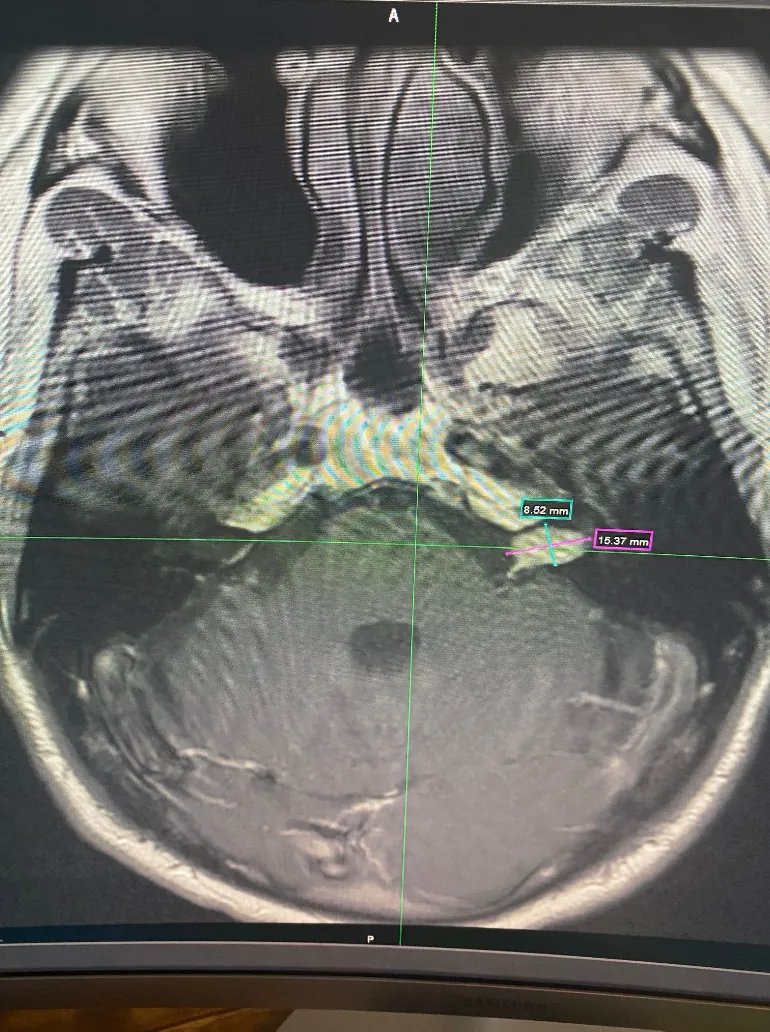 MRI scan showing Austin's brain tumor